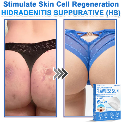 🎁SHIFENMEI™ 2-in-1 Microneedle & Hydrocolloid Patch | Raised Moles,Acne,  Flat Warts & Skin Tags Remover | Improves Wrinkles, Scars & Blemishes | Invisible Pimple Patches for Face & Body | 144 Count