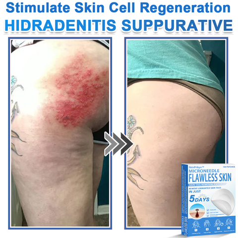 🎁SHIFENMEI™ 2-in-1 Microneedle & Hydrocolloid Patch | Raised Moles,Acne,  Flat Warts & Skin Tags Remover | Improves Wrinkles, Scars & Blemishes | Invisible Pimple Patches for Face & Body | 144 Count